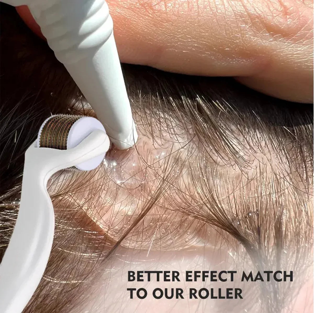 Microneedling behandeling voor haargroei met dermaroller op hoofdhuid, close-up