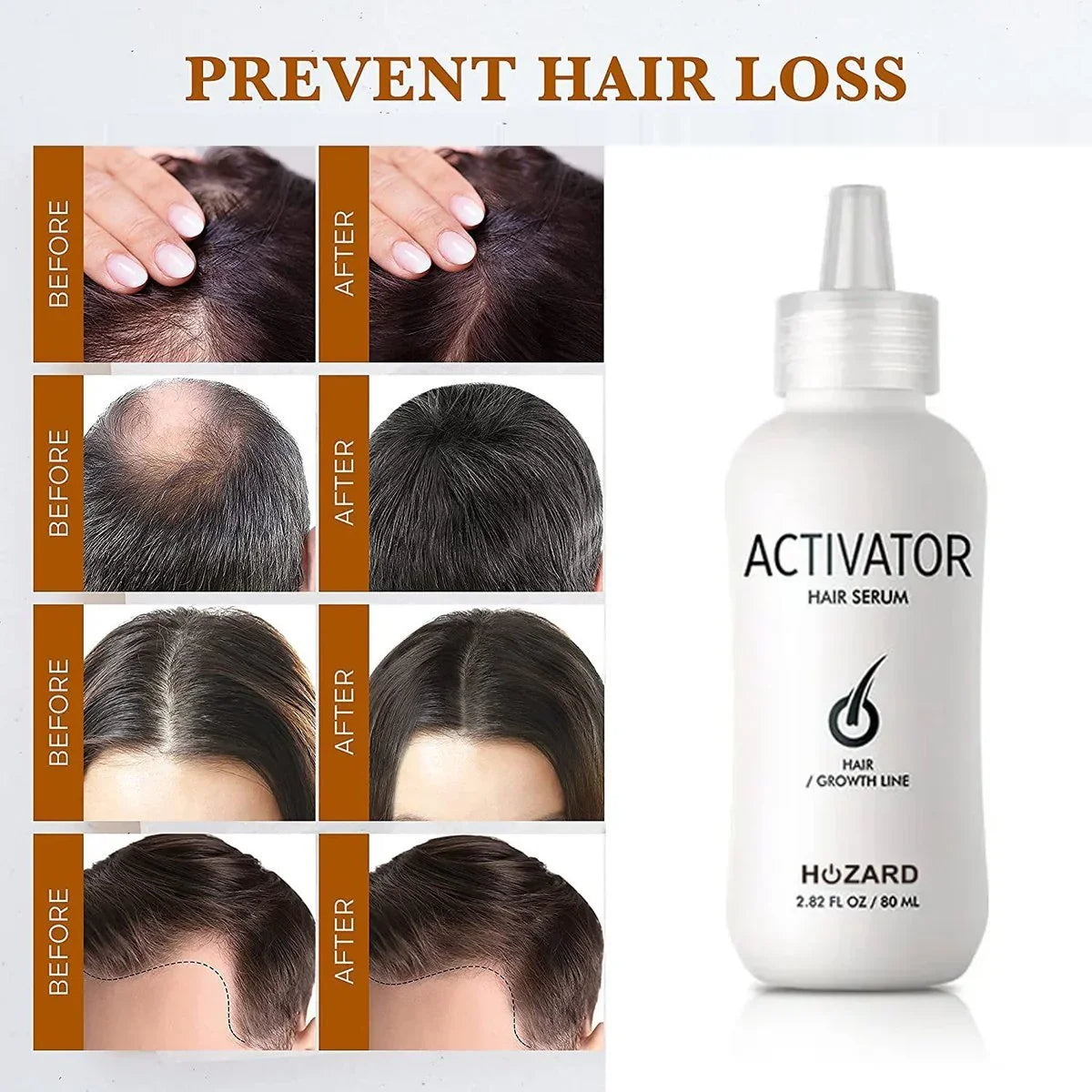 Voor en na foto's van haargroei door haarserum met fles Activator Hair Serum, haarverzorging.